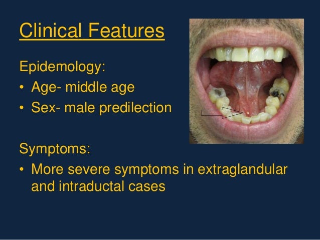 sialolithiasis
